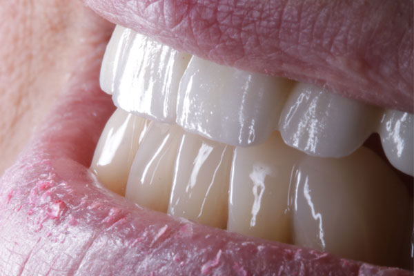 dientes-en-1-dia