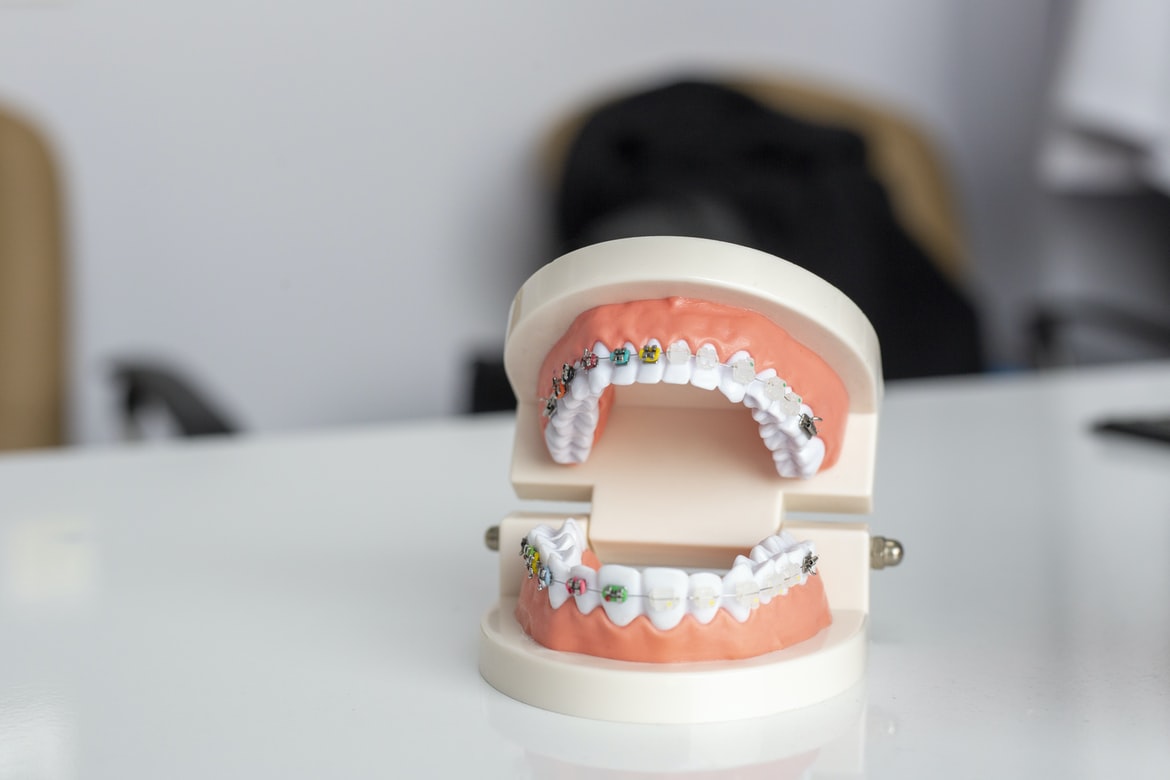 La retención en ortodoncia - Clínica La Victoria