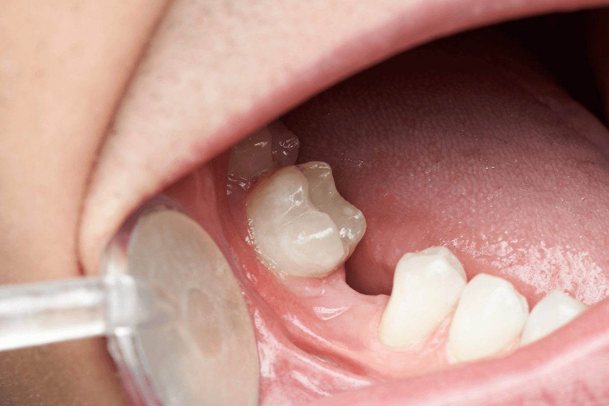 Cómo reponer un diente perdido - Clínica La Victoria