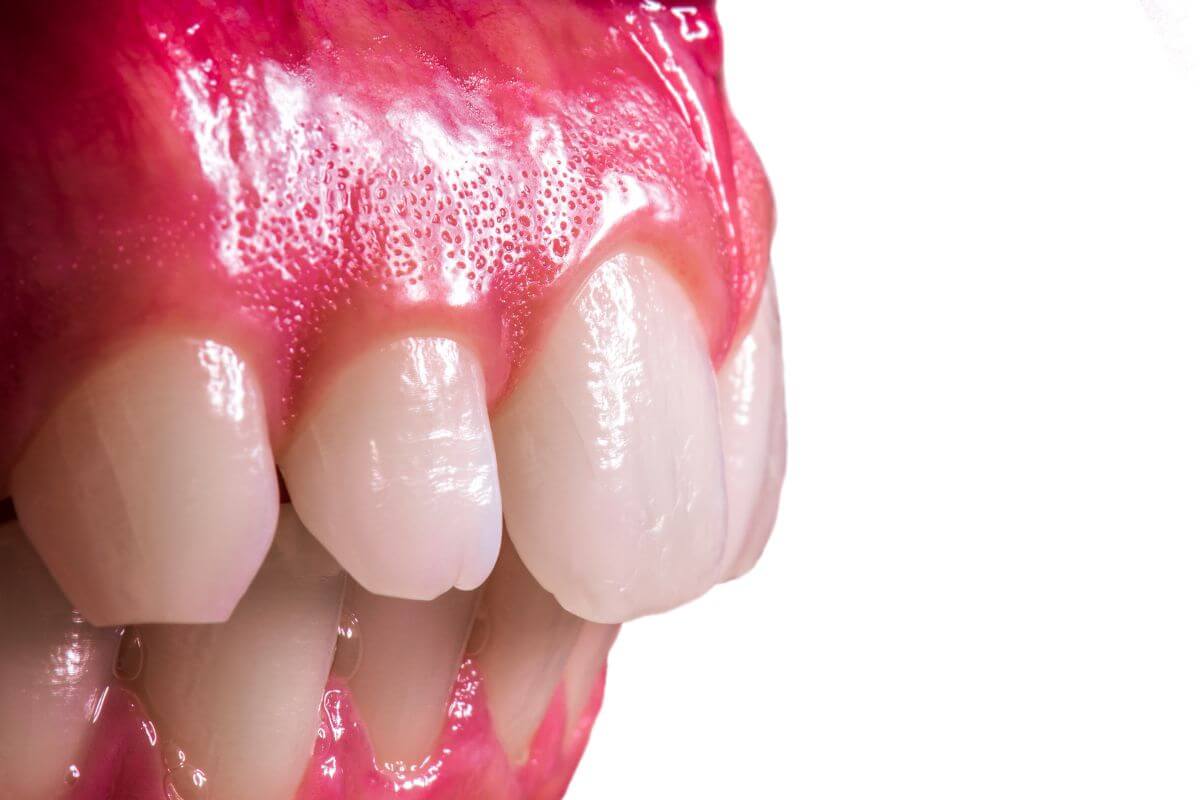 ¿Qué es el épulis dental? - Clínica La Victoria