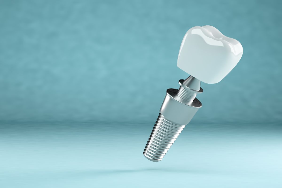 ¿Son los implantes dentales para toda la vida? - Clínica La Victoria