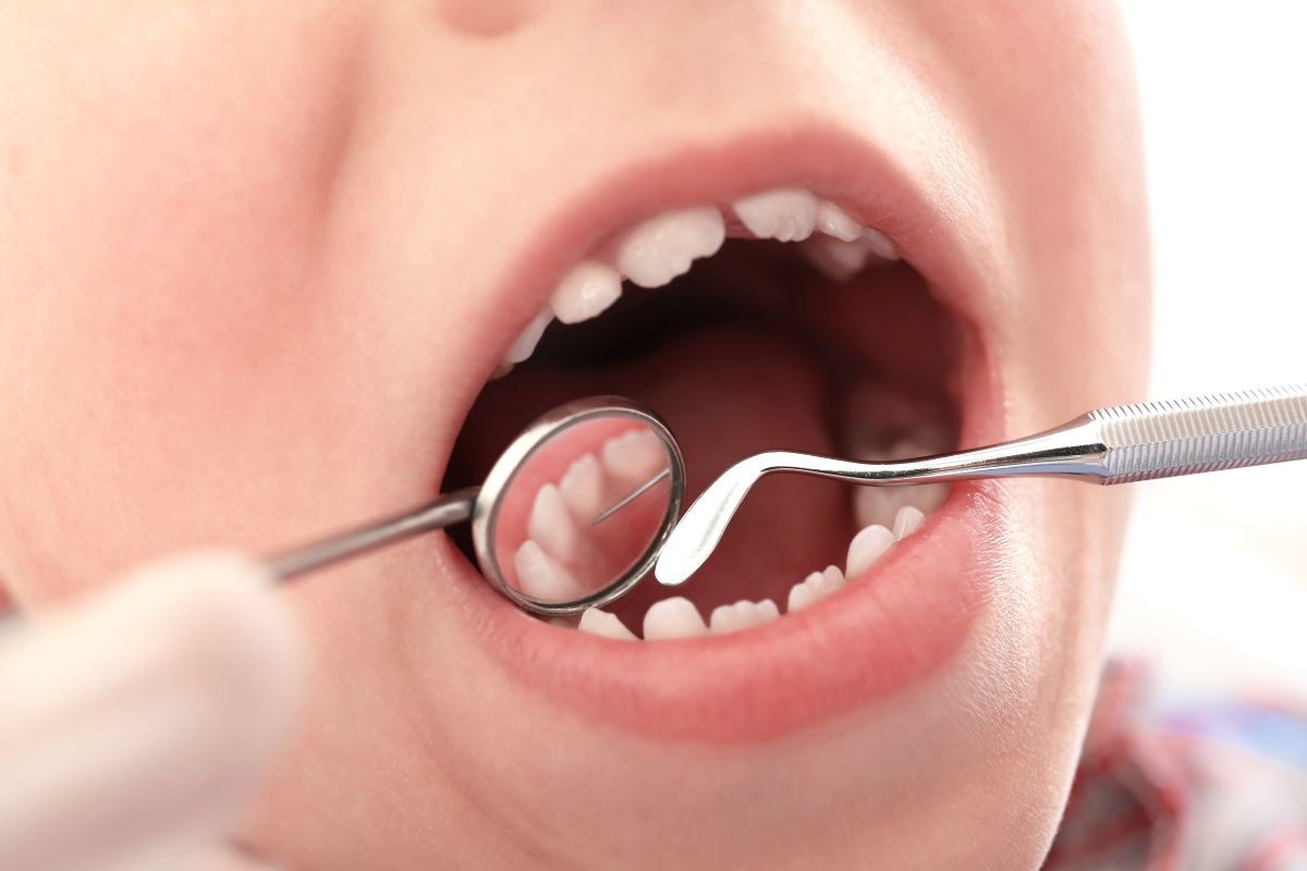 La importancia de los selladores de fisuras en la odontopediatría - Clínica La Victoria