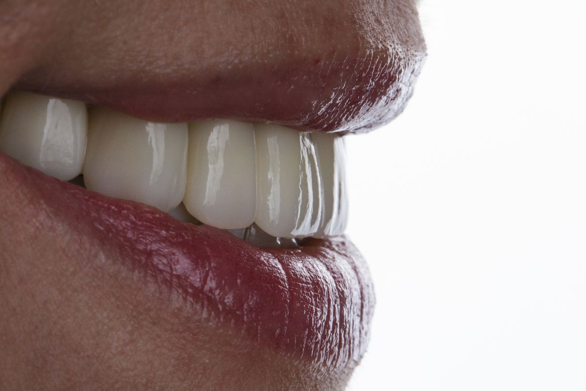 Tratamientos dentales carillas dentales sin tallado - Clínica La Victoria