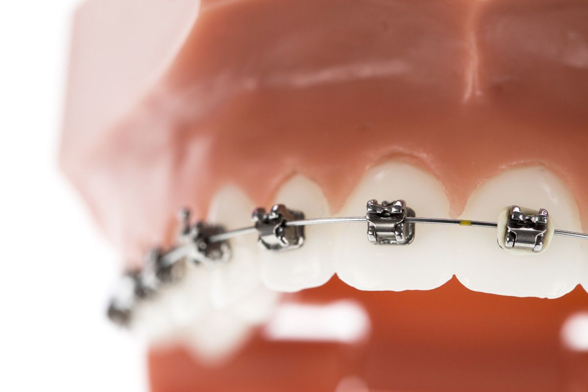 Tratamiento de ortodoncia por segunda vez - Clínica La Victoria