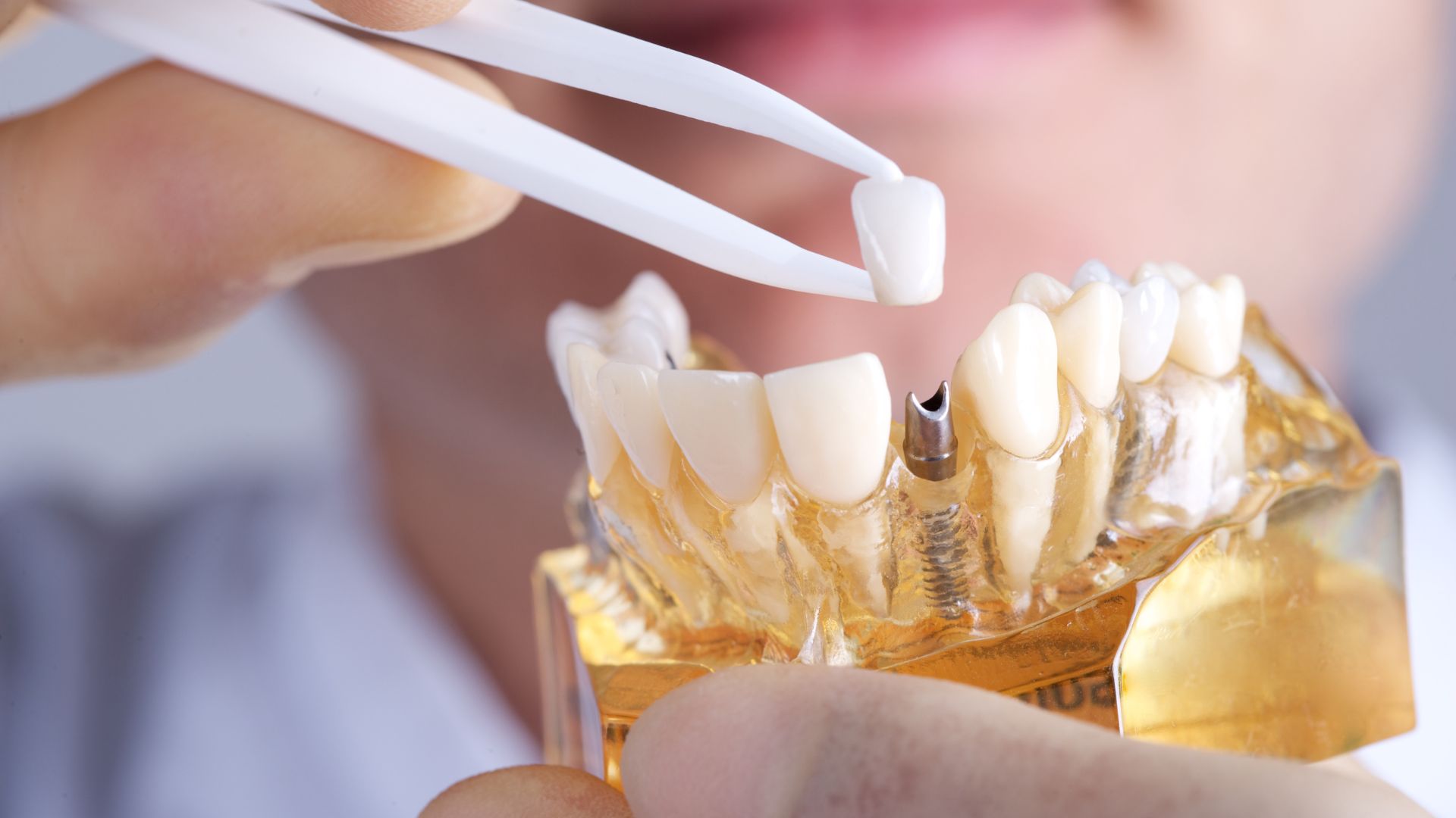 quitar los implantes dentales